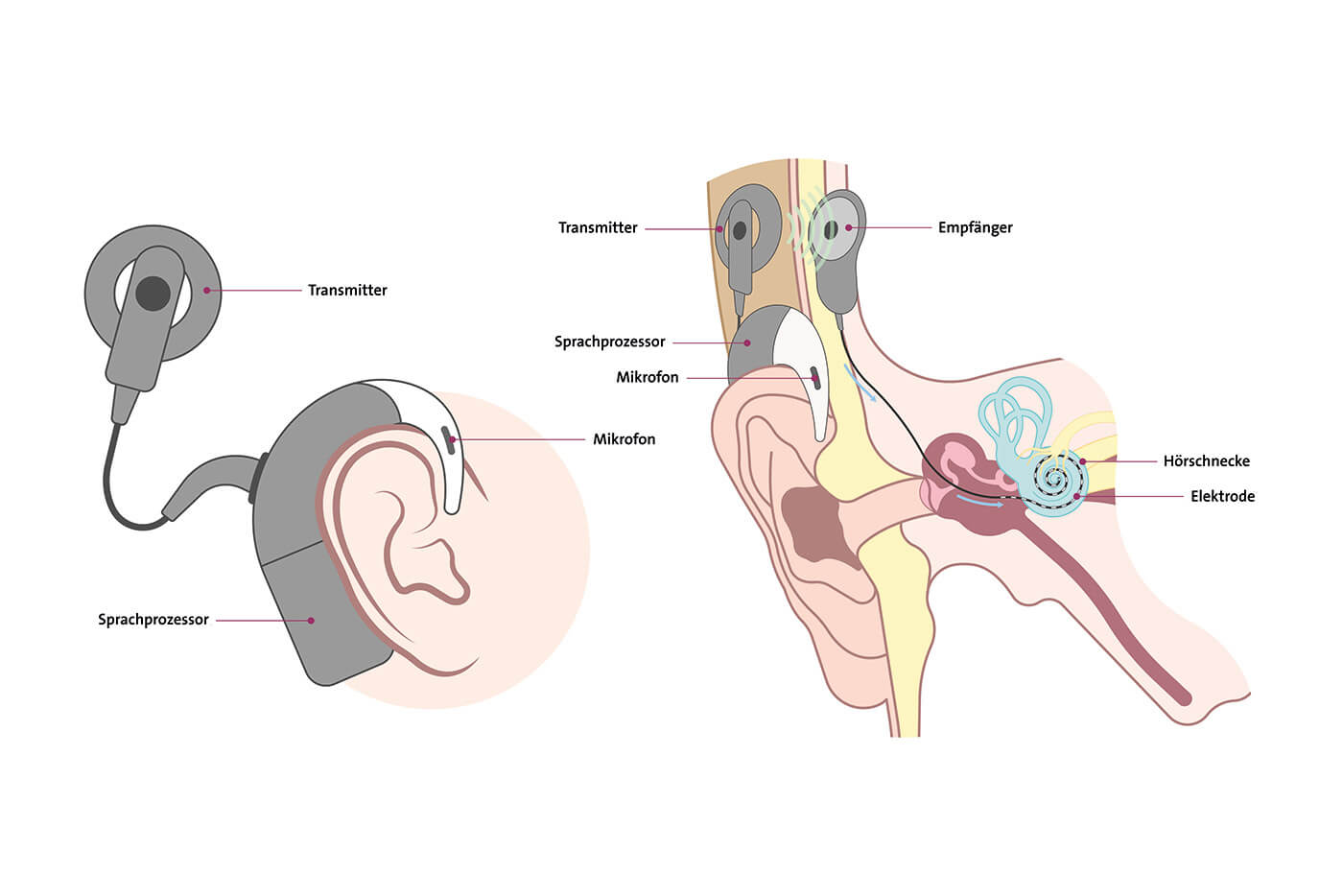 Schematisch dargestellt ist hier die Funktionsweise eines Cochlea-Implantates.